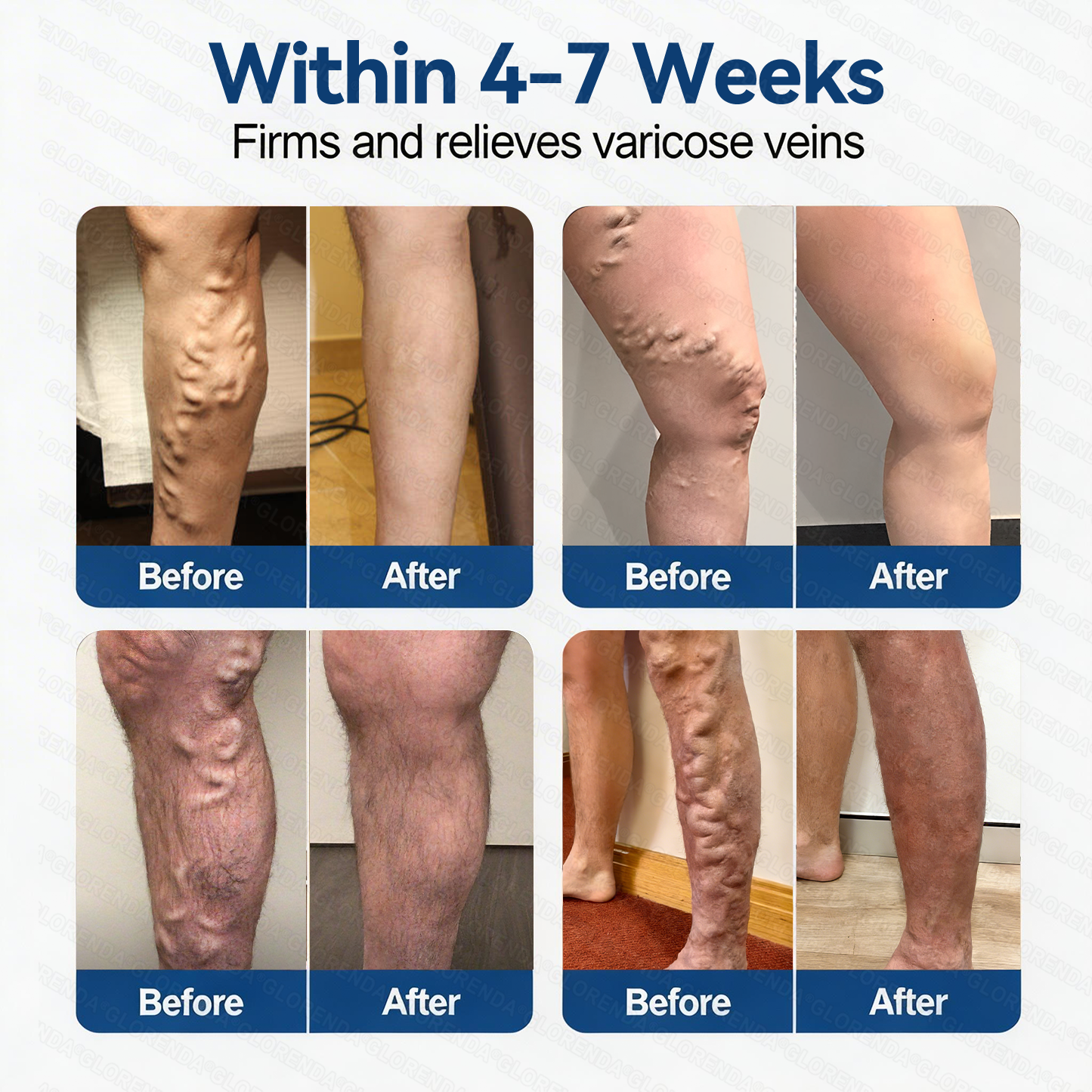 𝐆𝑳𝑶𝗥𝙀𝙉𝐃𝑨® 𝐕𝐞𝐢𝐧 𝐂𝐨𝐧𝐭𝐨𝐮𝐫 𝐌𝐢𝐜𝐫𝐨𝐧𝐞𝐞𝐝𝐥𝐞 𝐏𝐚𝐭𝐜𝐡 (𝐉𝐮𝐬𝐭 𝐎𝐧𝐜𝐞 𝐃𝐚𝐢𝐥𝐲, 𝐕𝐢𝐬𝐢𝐛𝐥𝐞 𝐑𝐞𝐬𝐮𝐥𝐭𝐬 𝐢𝐧 𝟕 𝐃𝐚𝐲𝐬) — 𝐒𝐮𝐢𝐭𝐚𝐛𝐥𝐞 𝐟𝐨𝐫 𝐕𝐚𝐫𝐢𝐜𝐨𝐬𝐞 𝐕𝐞𝐢𝐧𝐬 𝐚𝐧𝐝 𝐒𝐩𝐢𝐝𝐞𝐫 𝐕𝐞𝐢𝐧𝐬, 𝐇𝐞𝐥𝐩𝐬 𝐑𝐞𝐥𝐢𝐞𝐯𝐞 𝐋𝐞𝐠 𝐇𝐞𝐚𝐯𝐢𝐧𝐞𝐬𝐬, 𝐅𝐚𝐭𝐢𝐠𝐮𝐞, 𝐚𝐧𝐝 𝐉𝐨𝐢𝐧𝐭 𝐏𝐚𝐢𝐧