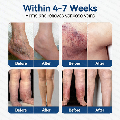 𝐆𝑳𝑶𝗥𝙀𝙉𝐃𝑨® 𝐕𝐞𝐢𝐧 𝐂𝐨𝐧𝐭𝐨𝐮𝐫 𝐌𝐢𝐜𝐫𝐨𝐧𝐞𝐞𝐝𝐥𝐞 𝐏𝐚𝐭𝐜𝐡 (𝐉𝐮𝐬𝐭 𝐎𝐧𝐜𝐞 𝐃𝐚𝐢𝐥𝐲, 𝐕𝐢𝐬𝐢𝐛𝐥𝐞 𝐑𝐞𝐬𝐮𝐥𝐭𝐬 𝐢𝐧 𝟕 𝐃𝐚𝐲𝐬) — 𝐒𝐮𝐢𝐭𝐚𝐛𝐥𝐞 𝐟𝐨𝐫 𝐕𝐚𝐫𝐢𝐜𝐨𝐬𝐞 𝐕𝐞𝐢𝐧𝐬 𝐚𝐧𝐝 𝐒𝐩𝐢𝐝𝐞𝐫 𝐕𝐞𝐢𝐧𝐬, 𝐇𝐞𝐥𝐩𝐬 𝐑𝐞𝐥𝐢𝐞𝐯𝐞 𝐋𝐞𝐠 𝐇𝐞𝐚𝐯𝐢𝐧𝐞𝐬𝐬, 𝐅𝐚𝐭𝐢𝐠𝐮𝐞, 𝐚𝐧𝐝 𝐉𝐨𝐢𝐧𝐭 𝐏𝐚𝐢𝐧